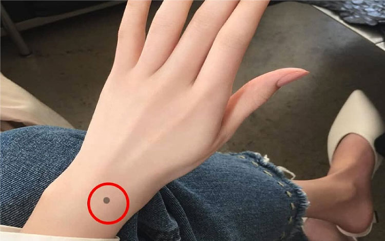 Nốt ruồi ở cổ tay bên trái