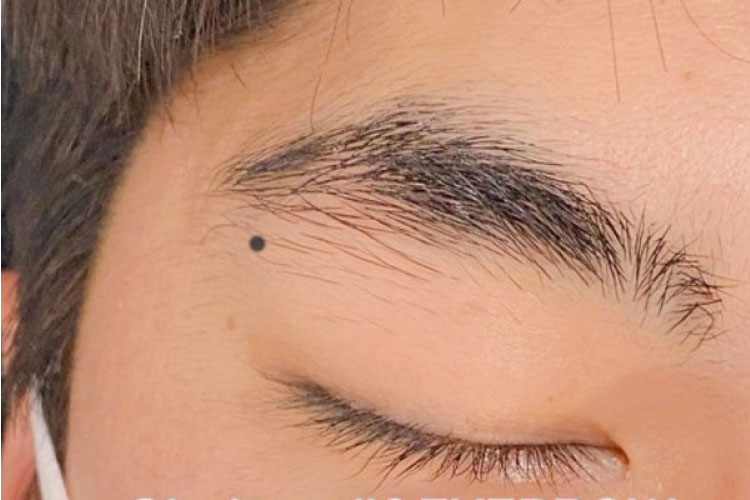Nốt ruồi nằm ở giữa lông mày và mắt của nam